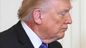 Trump sufre un gran sarpullido en su cuello en medio de tensión mundial: esto dijo su médico