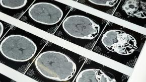 Duplicar la trombólisis, tratamiento para el ACV, podría ahorrar recursos al Estado sin aumentar el gasto en salud