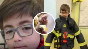 ¿Qué es la Escherichia coli? La bacteria que provocó muerte de niño de 8 años tras comer hamburguesa cruda