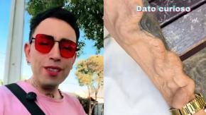 "Todo comenzó con una muela": Chileno cuenta cómo una infección le cambió la apariencia de su brazo