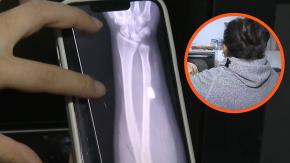La historia de la mujer que vive con una "bala perdida" en su brazo