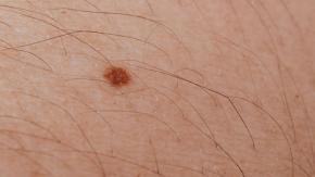 Así funciona a nivel molecular la nueva terapia contra el melanoma