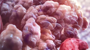 Descubren cómo el cáncer puede resistir la inmunoterapia