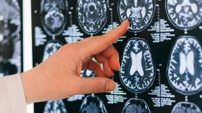 La epilepsia es más común en países de bajos ingresos