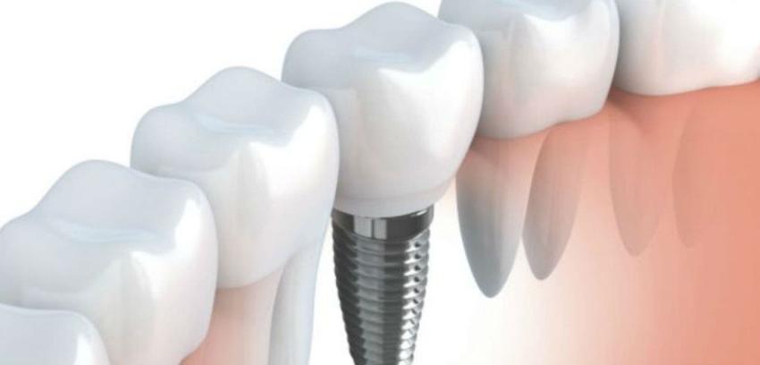 ¿Qué pasa si no se cuida a los implantes dentales como se debe?