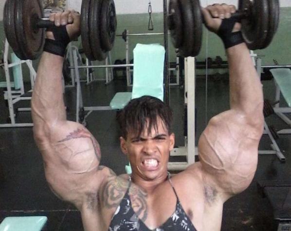 Impactante: Brasilero casi pierde los brazos al tratar de convertirse en Hulk