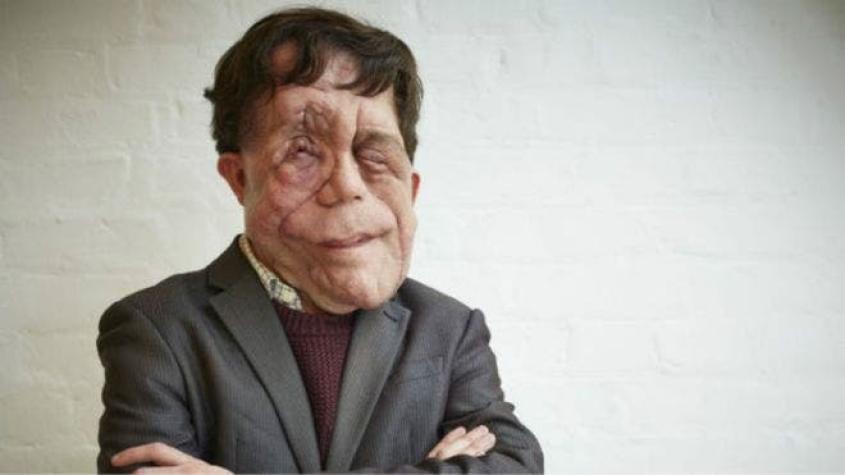 "Me han llamado mutante deforme": el drama de vivir con una desfiguración facial