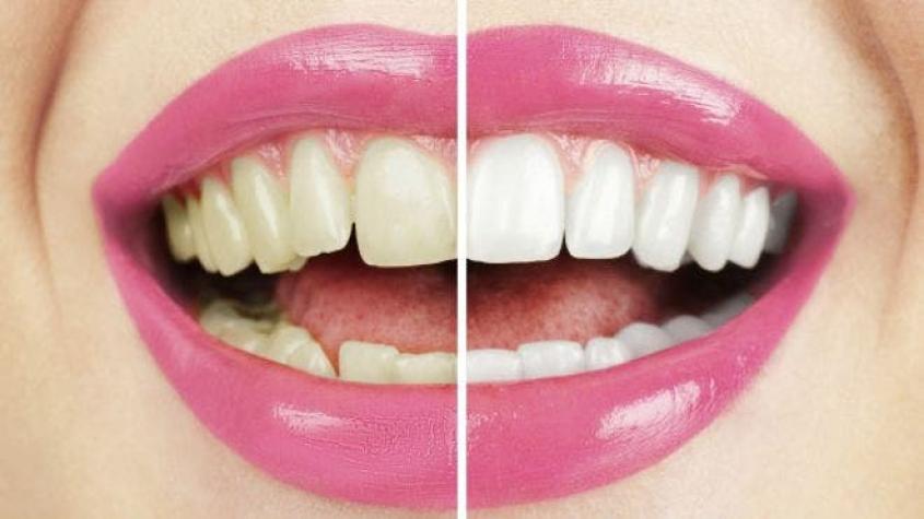 Los riesgos de blanquearse los dientes en casa o el salón de belleza