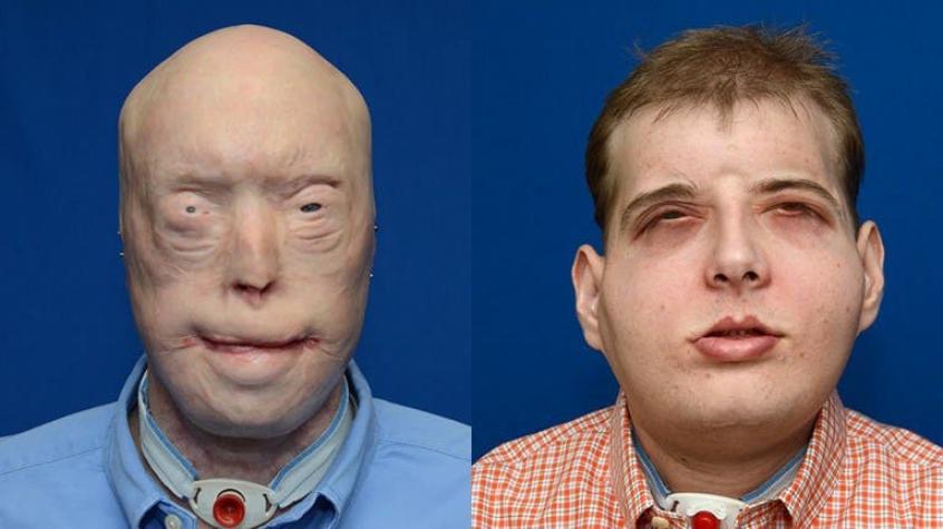 Muestran en Nueva York el increíble resultado de complejo trasplante de cara
