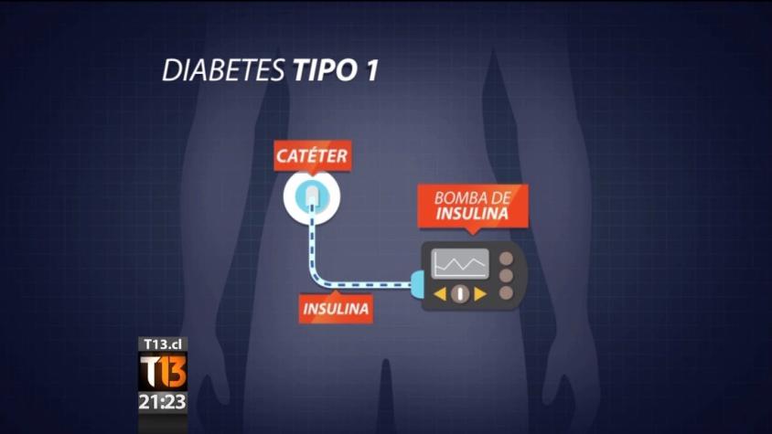 ¿En qué consiste la bomba de insulina para tratar la Diabetes?