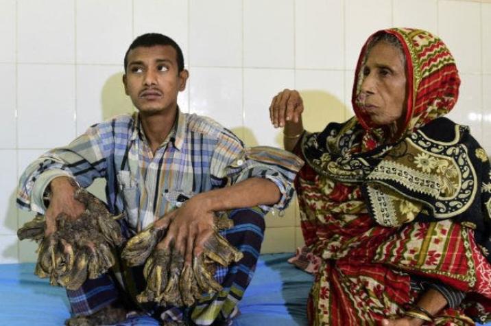 La extraña enfermedad del "hombre-árbol" de Bangladesh