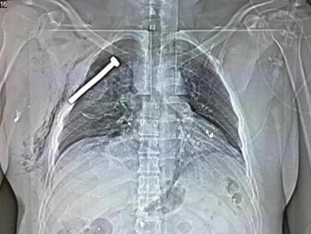 Impactante imagen de rayos X de una persona herida en el ataque terrorista de Bruselas