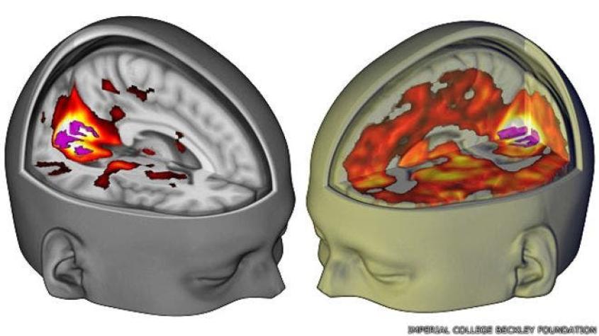 La imagen del cerebro bajo los efectos del LSD por la que los científicos esperaron 50 años