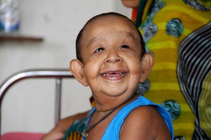 Misteriosa enfermedad hace que niño bangladesí de cuatro años parezca un anciano
