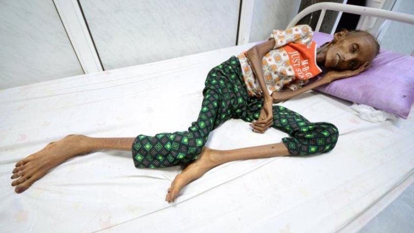 La historia detrás de las impactantes imágenes de la niña símbolo del hambre en Yemen