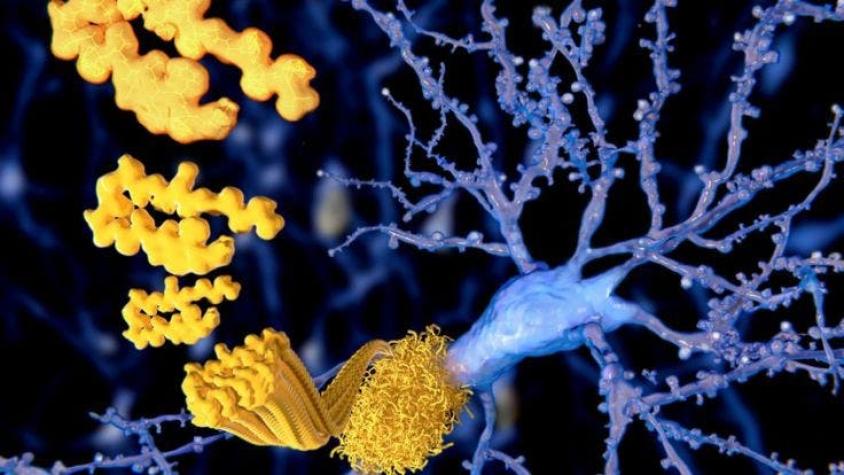Nuevo medicamento para combatir el mal de Alzheimer genera expectativas y esperanza