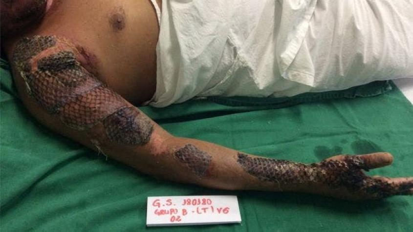 El revolucionario método desarrollado en Brasil para tratar quemaduras graves con piel de pez