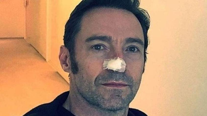 Qué es el carcinoma basocelular, el cáncer de piel que sufre el actor Hugh Jackman