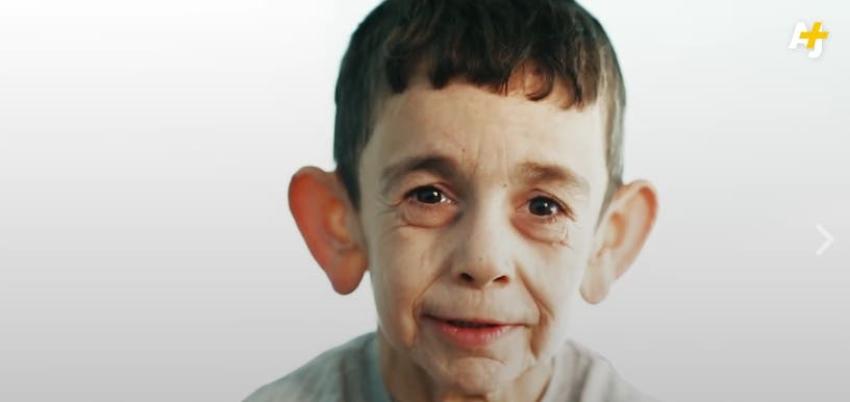 La trágica historia de un niño sirio con progeria que se hizo viral