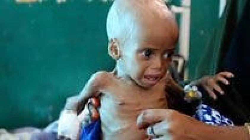 [VIDEO] La agonía de los niños desnutridos que no tienen fuerza ni para llorar