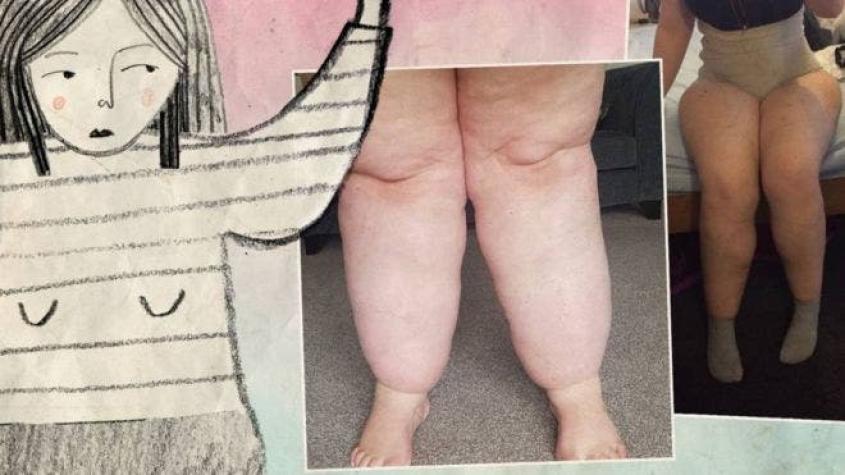 "No estoy gorda: sufro de lipedema"