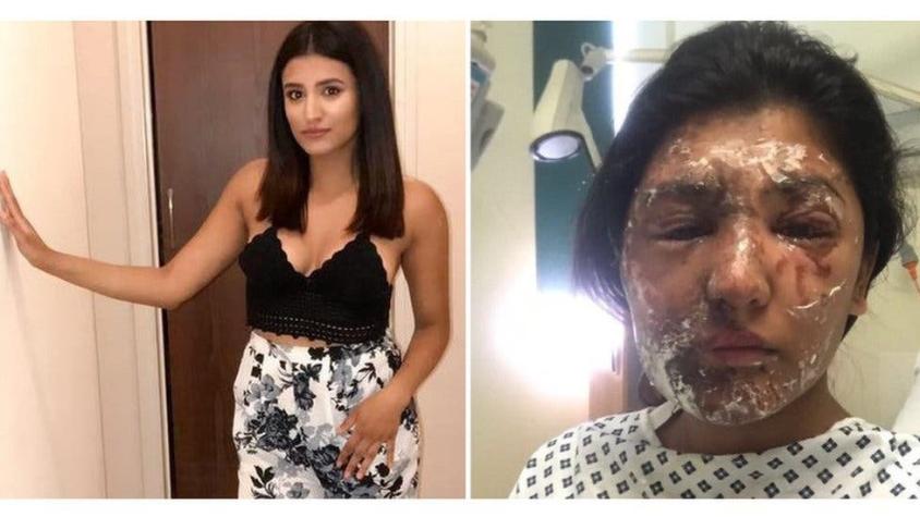"Volveré a lucir bien", el mensaje esperanzador de una joven atacada con ácido en el Reino Unido