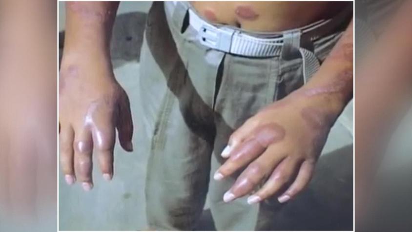 [VIDEO] Se confirman casos de lepra en Chile