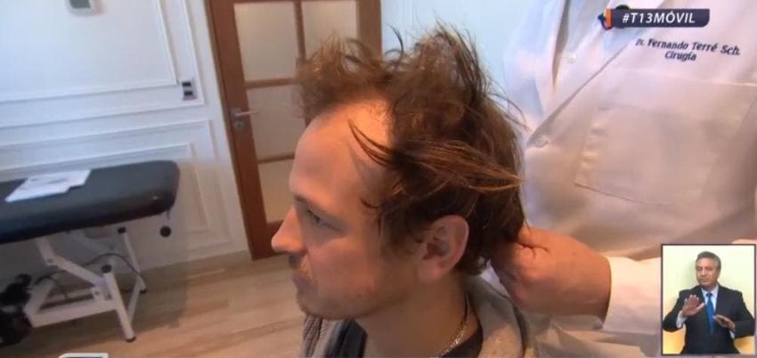 [VIDEO] La batalla contra la alopecia: injertos de pelo aumentaron 300% desde 2016