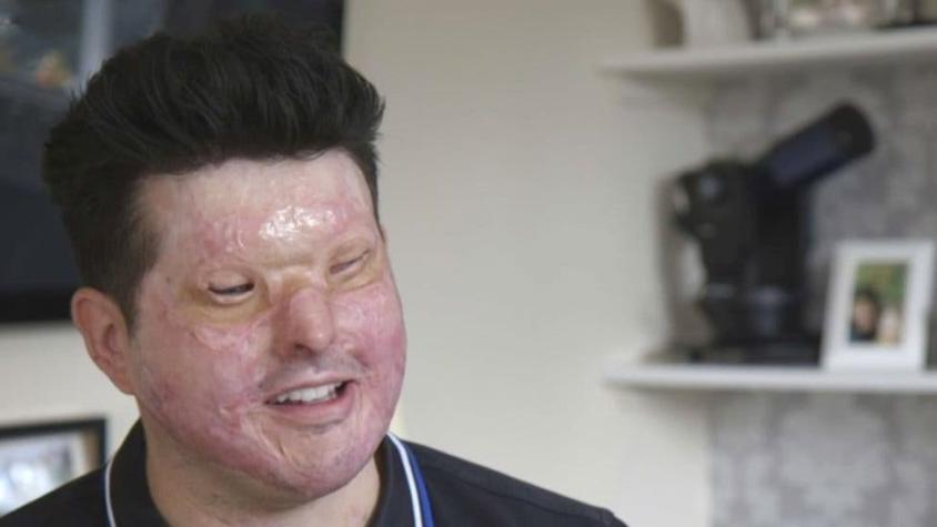 Hablan las víctimas de ataques de ácido en Reino Unido que fueron elegidas al azar