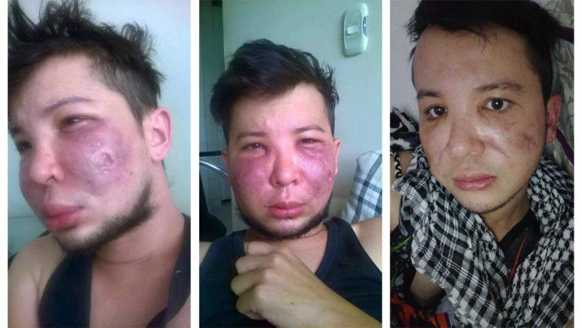"Tenía mi cara destruida, podrida":los peligros de caer en malas manos al hacerse cirugías estéticas