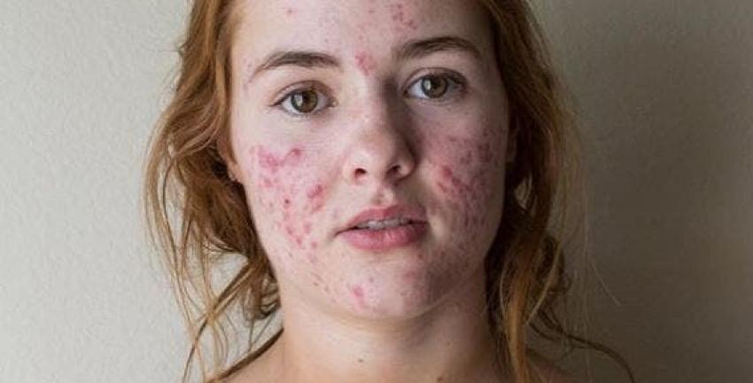 La increíble transformación de una joven con un agresivo cuadro de acné