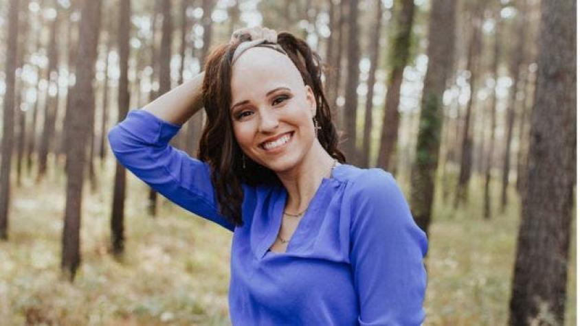 Makenzee Meaux, la mujer de 21 años que compartió su alopecia por Internet