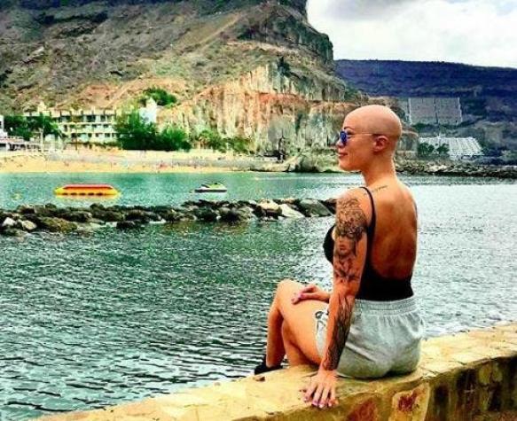 "No necesito esconderme más": La historia de una joven que sufrió alopecia y que ahora es modelo
