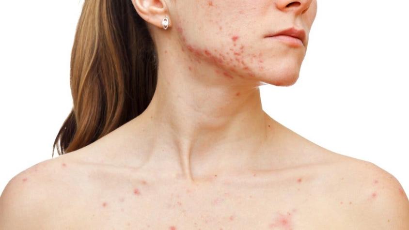 5 cosas que no debes decirle a alguien con acné