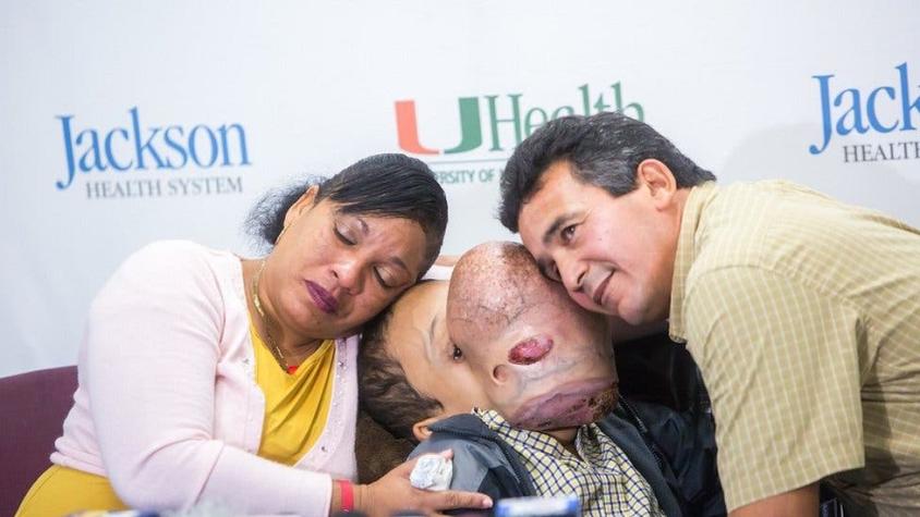 Murió Emanuel, el niño cubano con un gigantesco tumor en la cara que fue operado en Estados Unidos