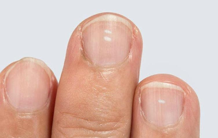 ¿Has tenido marcas blancas en tus uñas? Esta es la razón por la que aparecen