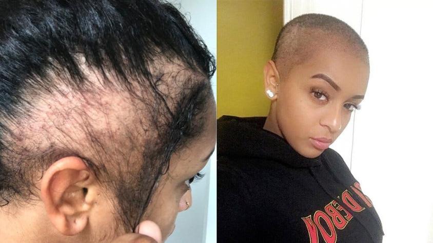 "Mi peinado terminó dejándome calva": La joven que sufre alopecia por tracción
