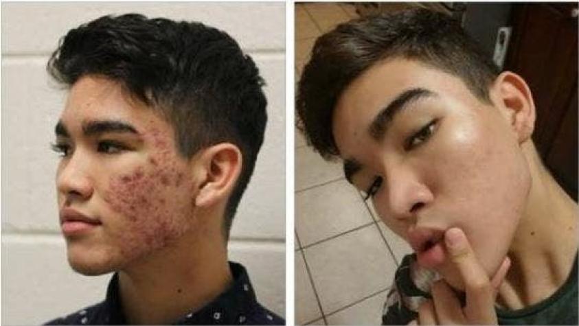 El radical cambio de un joven que tenía acné severo gracias a un curioso tratamiento