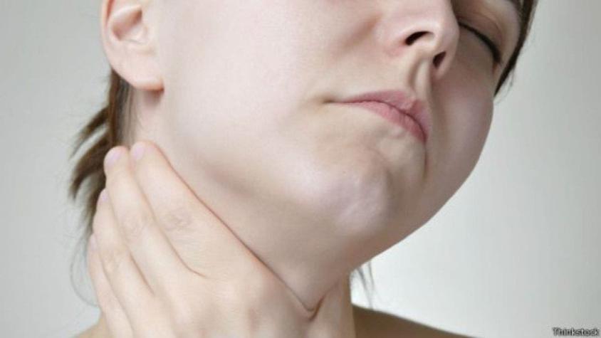 #VidaYSalud: ¿Cómo identificar el hipotiroidismo?