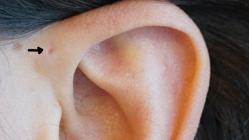 El seno preauricular: ¿Por qué algunas personas tienen un orificio en la parte superior de la oreja?