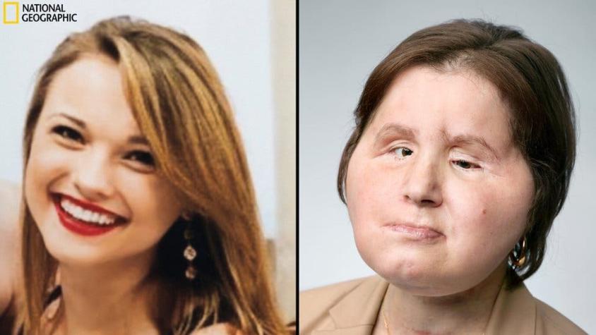 El histórico trasplante de rostro que le dio una segunda oportunidad a una joven