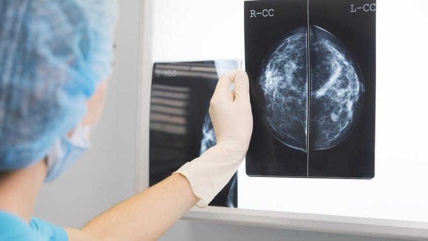 Por qué hay científicos que quieren dejar de llamar cáncer a algunos tumores