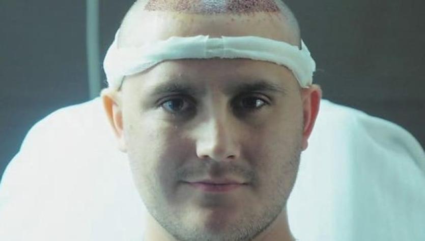 [VIDEO] Los hombres que gastan miles de dólares para un trasplante de pelo
