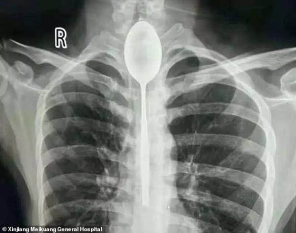 Hombre vivió por más de un año con una cuchara de 20 centímetros en su garganta