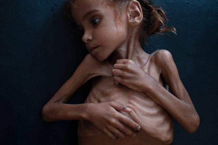 Muere Amal Hussain, símbolo de la hambruna infantil en Yemen