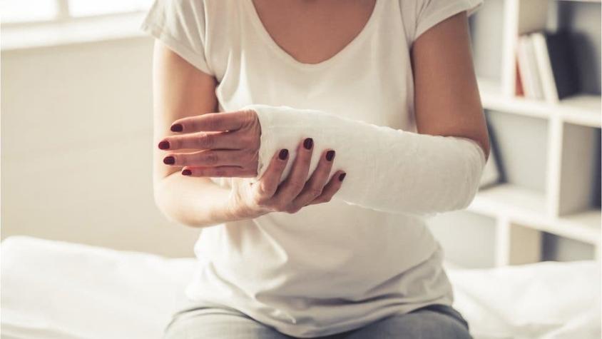 5 mitos comunes sobre fracturas de huesos y por qué no son ciertos