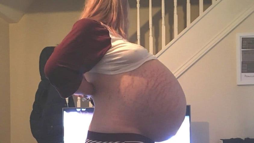 Le decían que estaba embarazada, pero en realidad tenía un quiste de ovario de 26 kilos