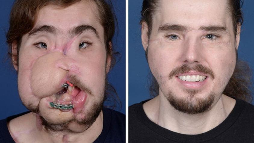El joven al que un trasplante de rostro le devolvió la sonrisa después de un intento de suicidio