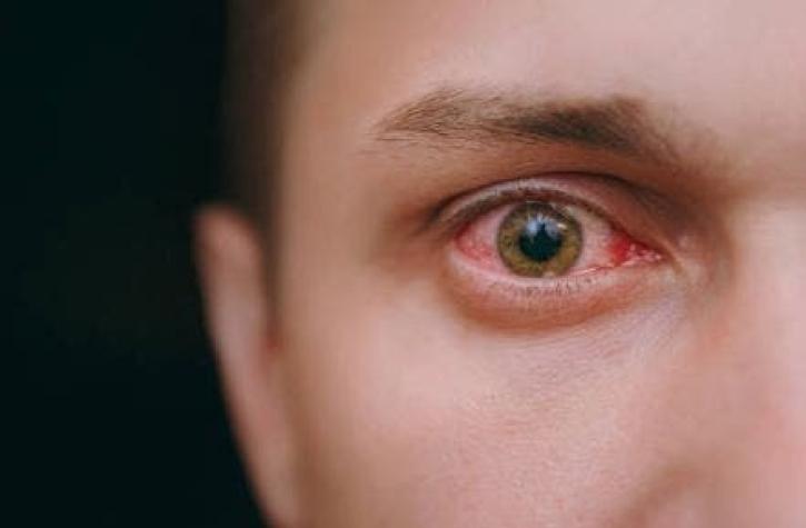 Parásito de los párpados podrían ser la causa de los ojos rojos
