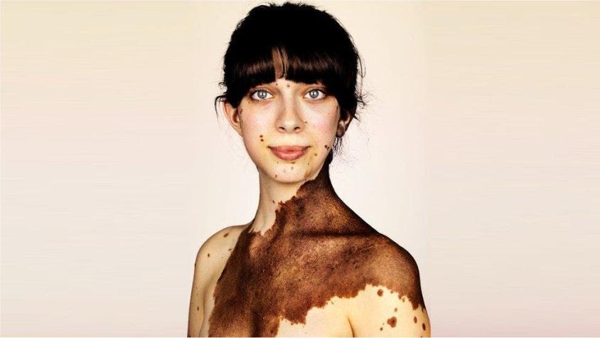 [FOTOS] Las imágenes que muestran la extraña condición que cubre la piel de manchas oscuras
